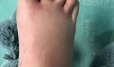 Bicho geográfico: confira suas causas, sintomas e tratamentos...