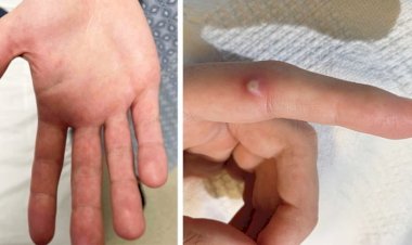 OMS relata 14.000 casos de varíola do macaco no mundo e cinco mortes na África